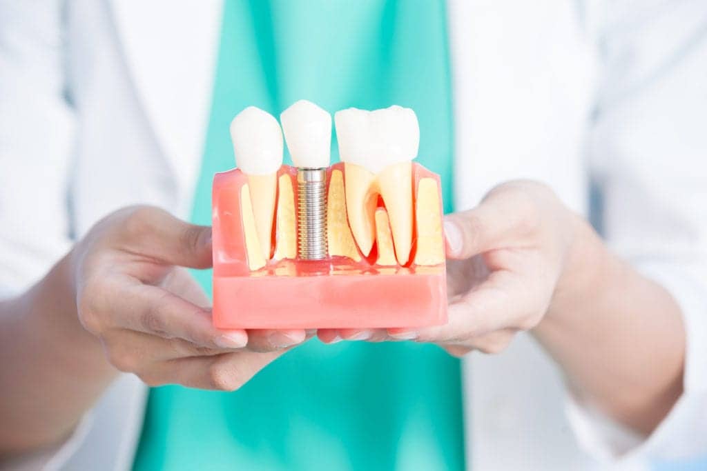7 Noteworthy Reasons Behind the Popularity of Dental Implants